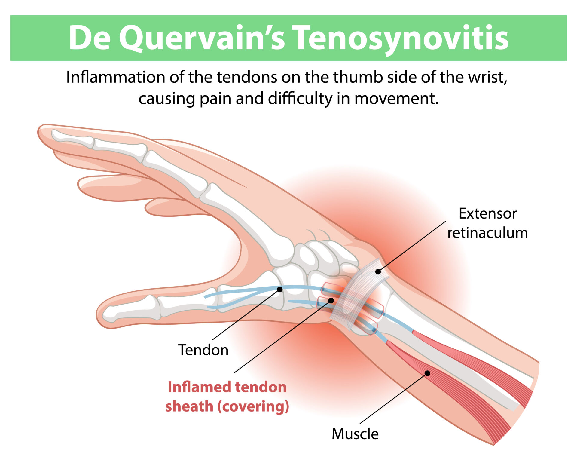 Tendovaginitis De Quervain Op Komplikationen